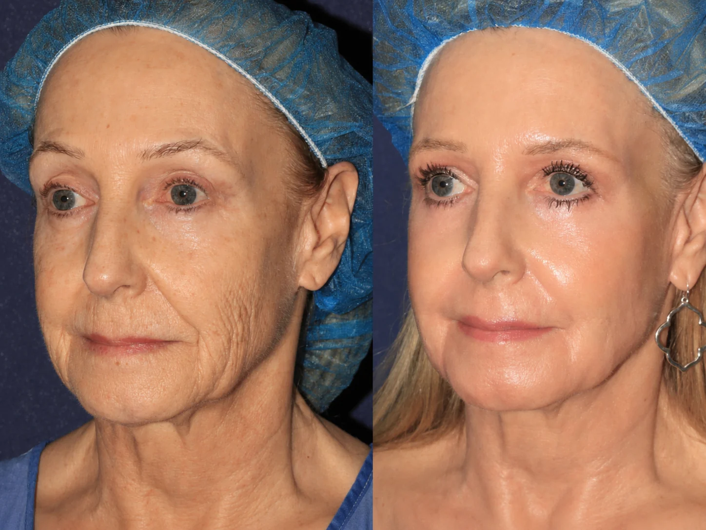 TopSpire® Facility Botox-Inspired Pure Collagen Firming Wand