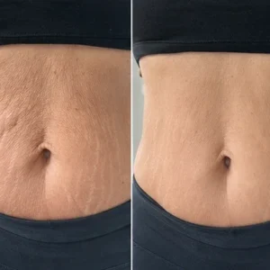 TopSpire® Facility Botox-Inspired Pure Collagen Firming Wand