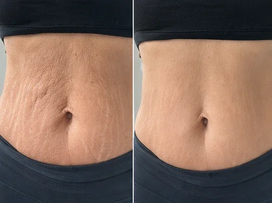 TopSpire® Facility Botox-Inspired Pure Collagen Firming Wand