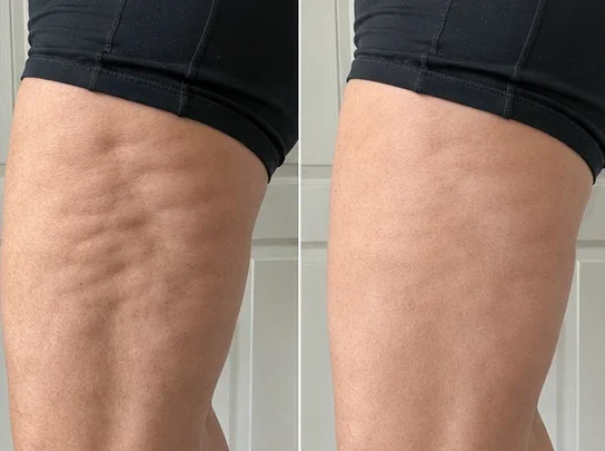 TopSpire® Facility Botox-Inspired Pure Collagen Firming Wand